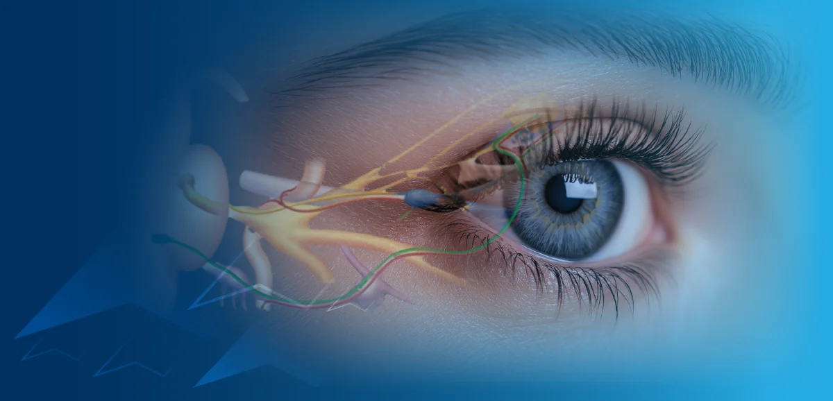 بررسی پیشرفت پیرچشمی در بیماران مبتلا به گلوکومِ تحت درمان با آگونیستهای گیرندهٔ پروستاگلاندین F (FP)